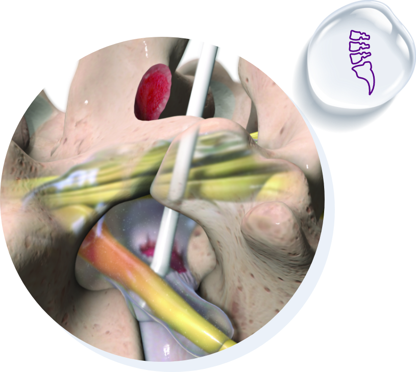 Fziomed | Reduce Post-Surgical Adhesions | Spine Surgery