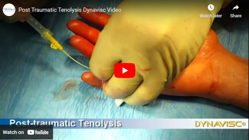 Dynavisc Adhesion Barrier Gel application - post-traumatic tenolysis live surgery video